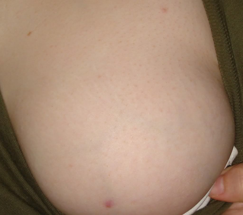 Breast Acne Pictures
